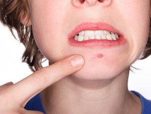 Foto Noticia Estr�s y hormonas favorecen el brote de acn� en adultos